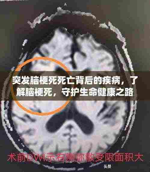 突发脑梗死死亡背后的疾病,了解脑梗死,守护生命健康之路