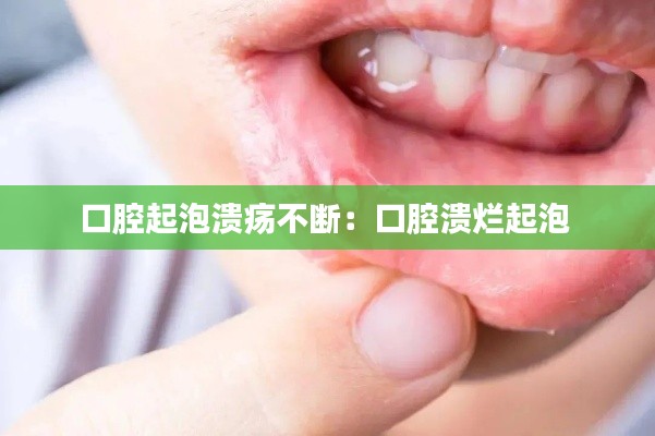 口腔起泡溃疡不断:口腔溃烂起泡