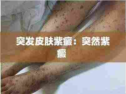 突发皮肤紫癜:突然紫癜